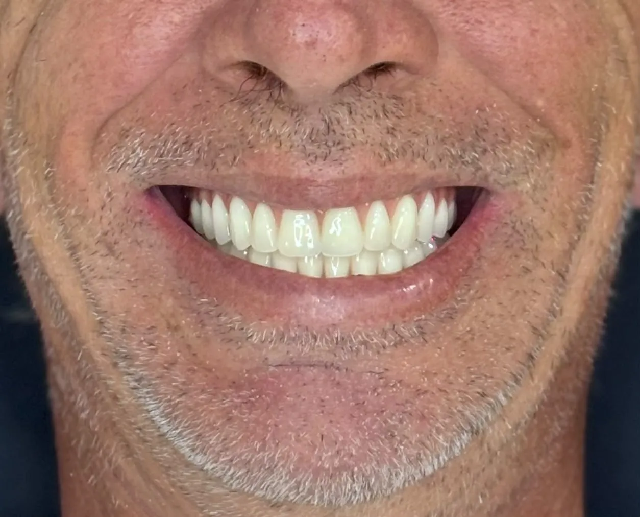 Reabilitação oral — depois