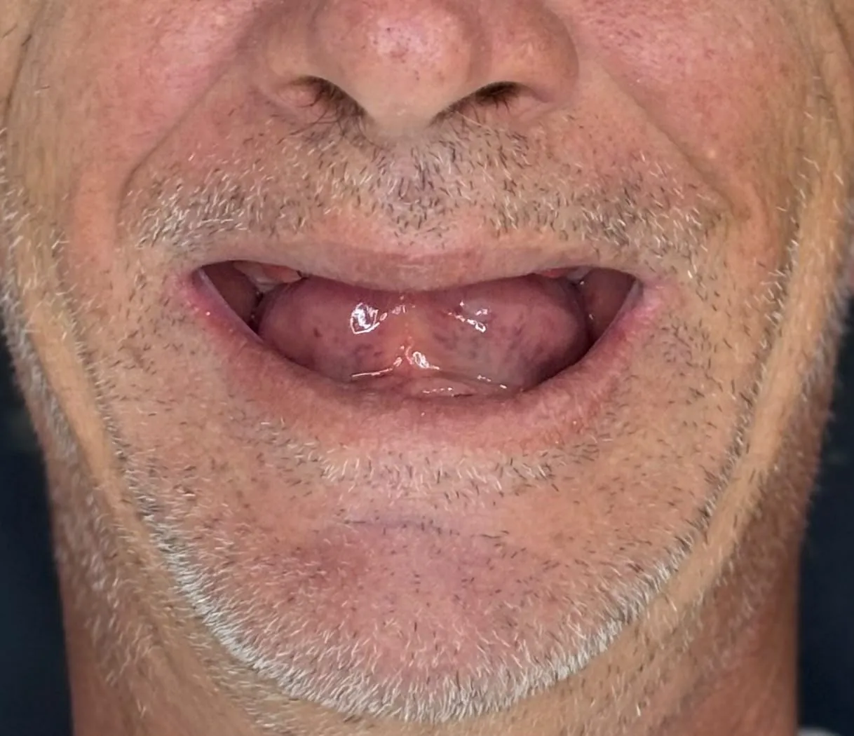 Reabilitação oral — durante