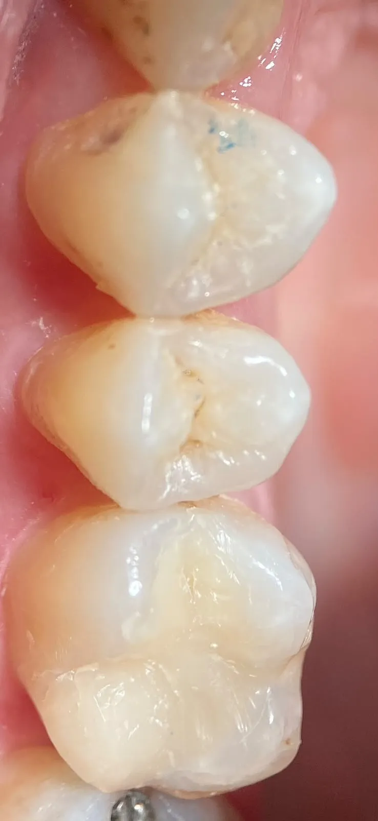Restauração estética — depois
