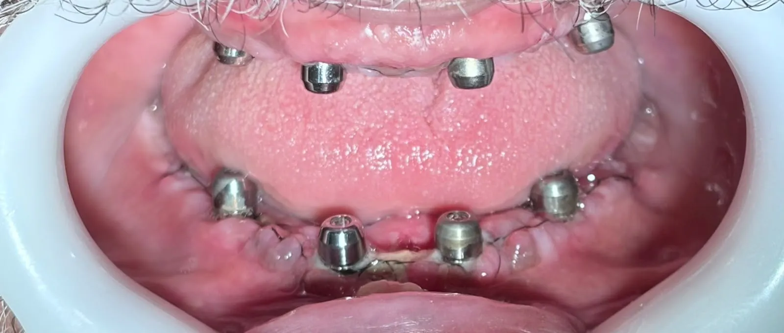 Prótese protocolo sobre implantes — implantes